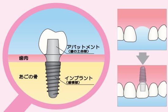 インプラントとは?
