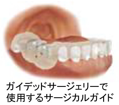 ガイデッドサージェリーで使用するサージカルガイド