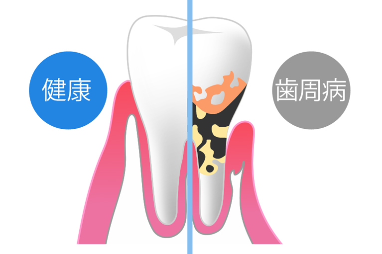 歯周病チェックを徹底